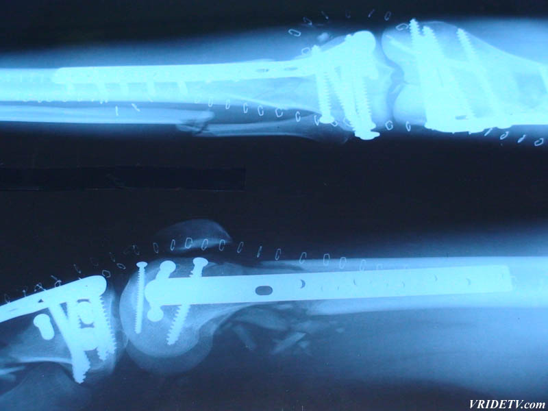 X-rays of leg after horrific motorcycle accident. vridetv.com